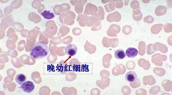 红细胞检测之有核红细胞篇