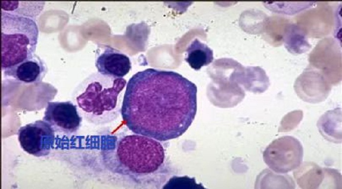 红细胞检测之有核红细胞篇
