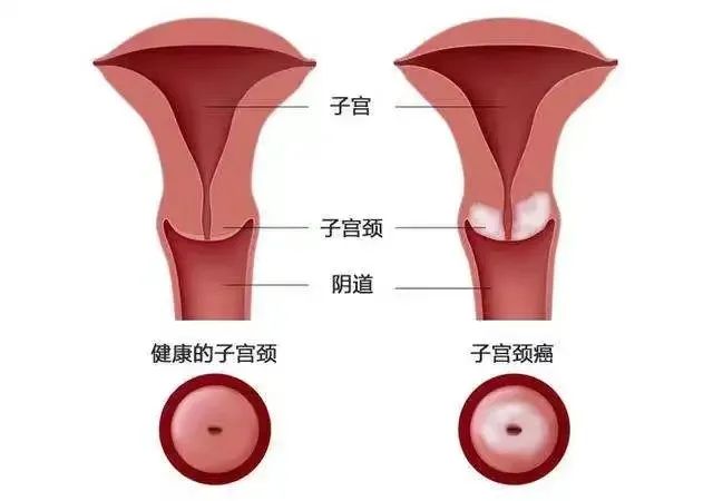 宫颈癌与男性有关？男女必知的常识！