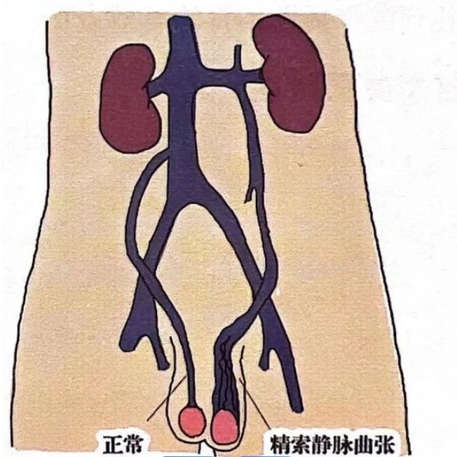 阴囊里的“小蚯蚓”——精索静脉曲张是怎么回事？