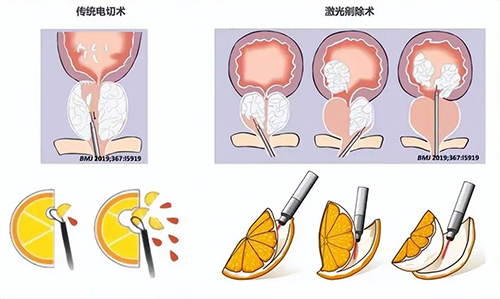 传统电切与激光剜除大对决,前列腺增生患者如何选?
