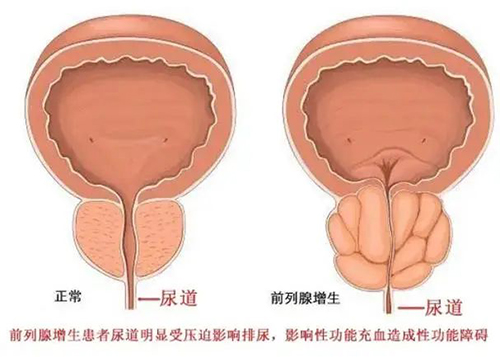 传统电切与激光剜除大对决,前列腺增生患者如何选?