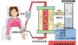 血液透析你了解多少？